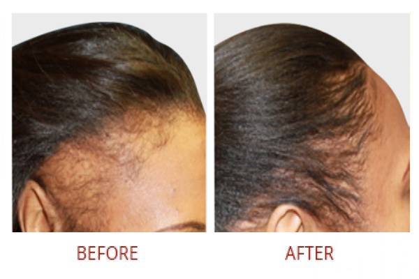 smp before after left