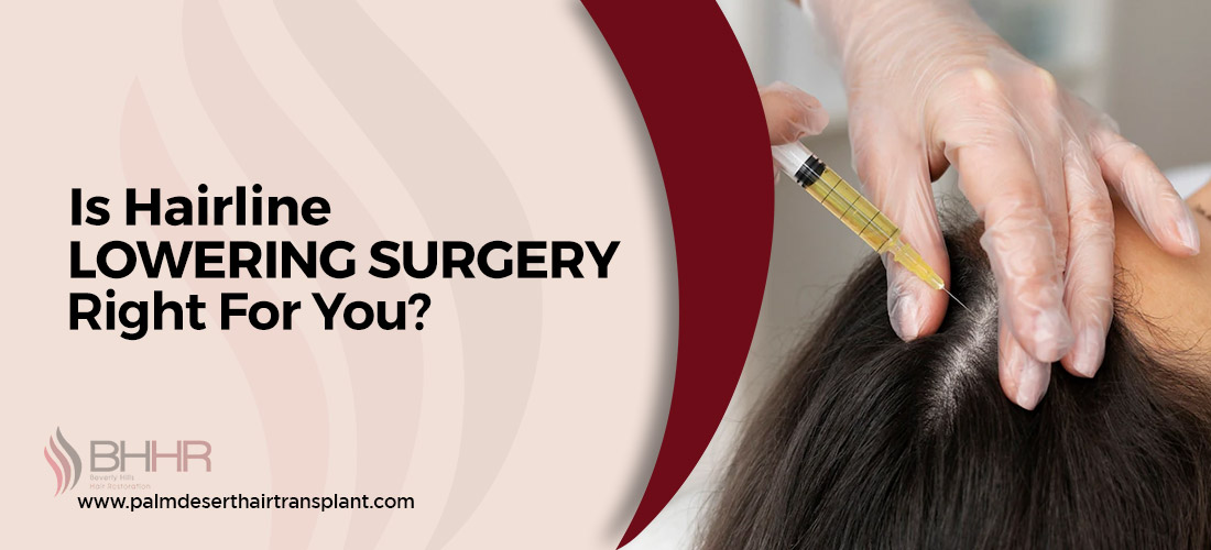 hairline lowering surgery 