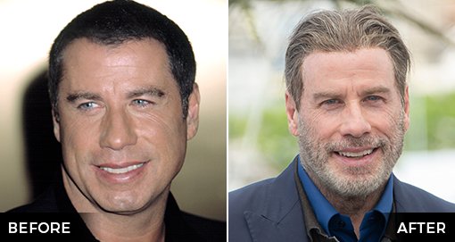 John Travolta Hair Transplant