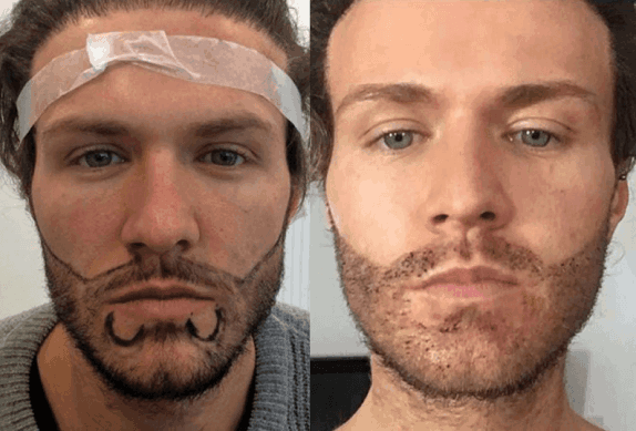 Facial hair restoration