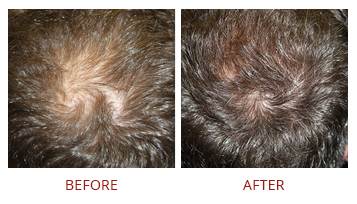platelet-rich-plasma-prp-hair-restoration