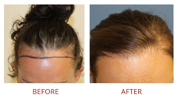 Fue Hair Transplant Female Before After 1