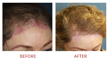 Fue Hair Transplant Female Before After 2