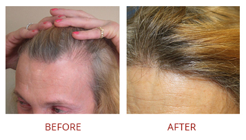 Fue Hair Transplant Female Before After