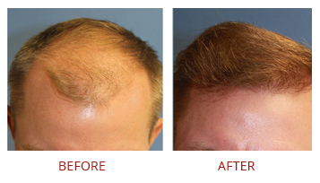 Fue Hair Transplant Male Before After 1