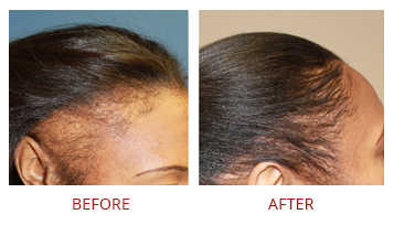 Hair restoration Female Before After 1
