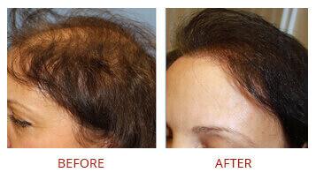 Hair restoration Female Before After 2