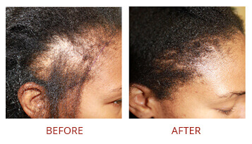 Hair restoration Female Before After
