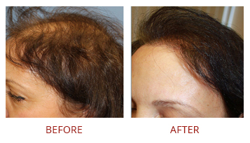 Hair Transplant Female Before After 2