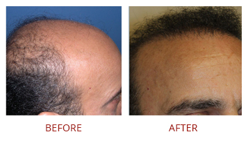 Hair Transplant Male Before After 2