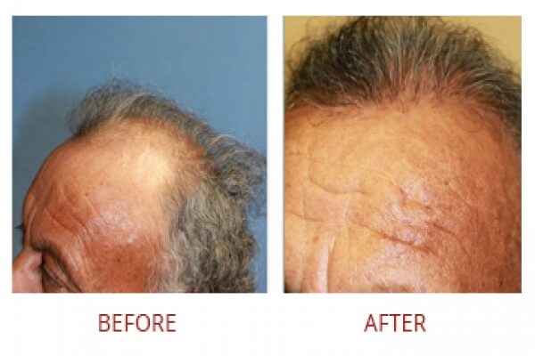 Hair Transplant Male Before After