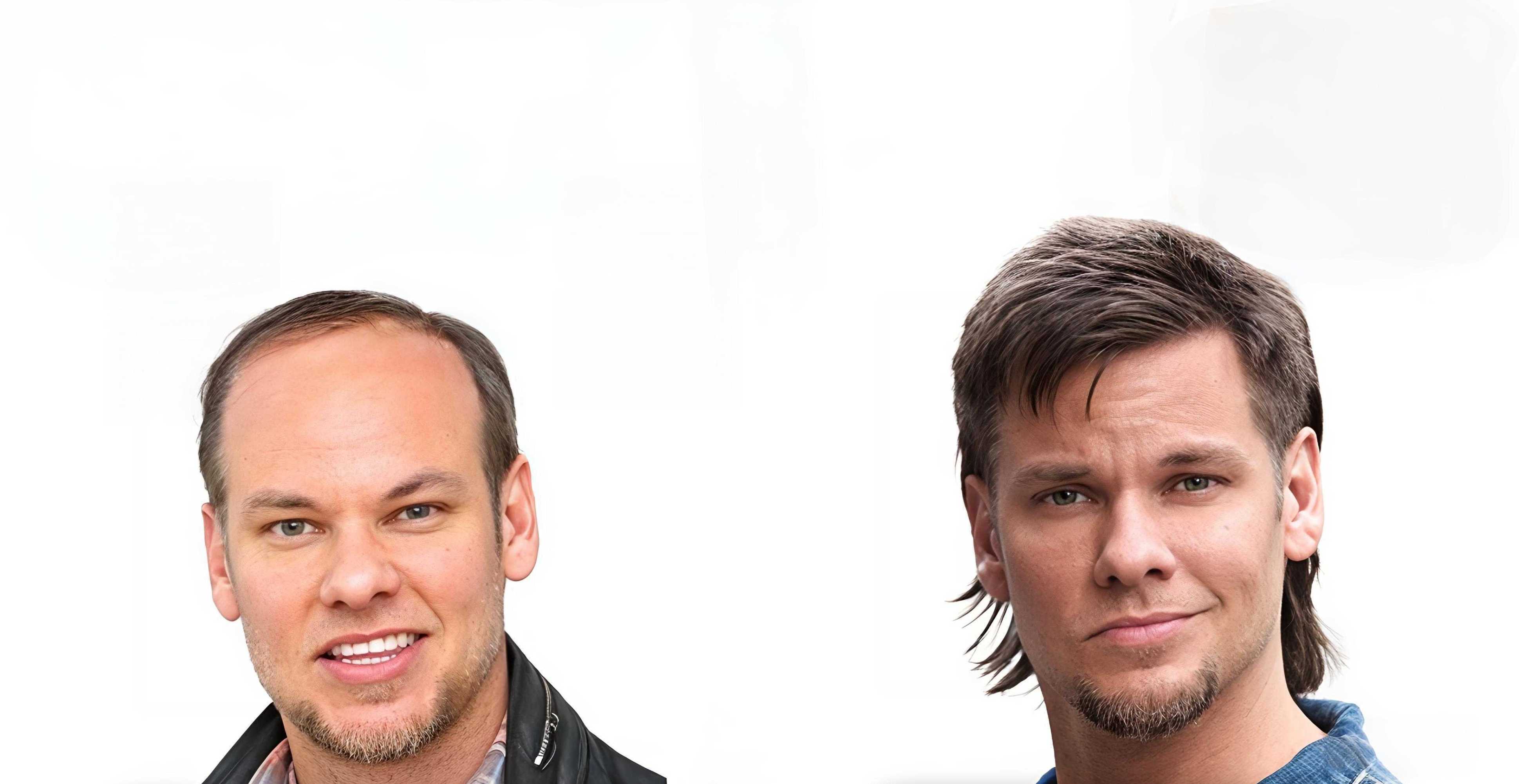theo von hair transplant journey
