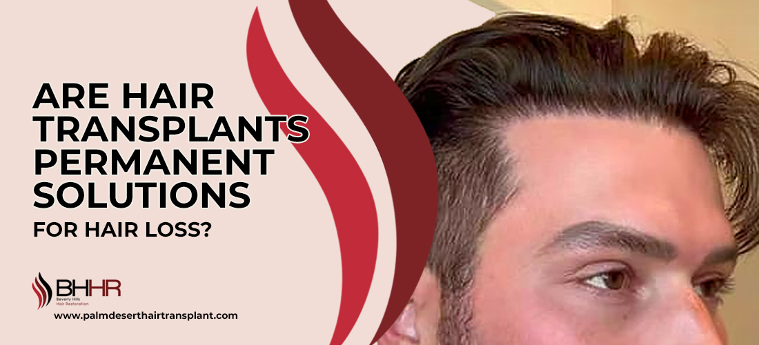 Are Hair Transplants Permanent