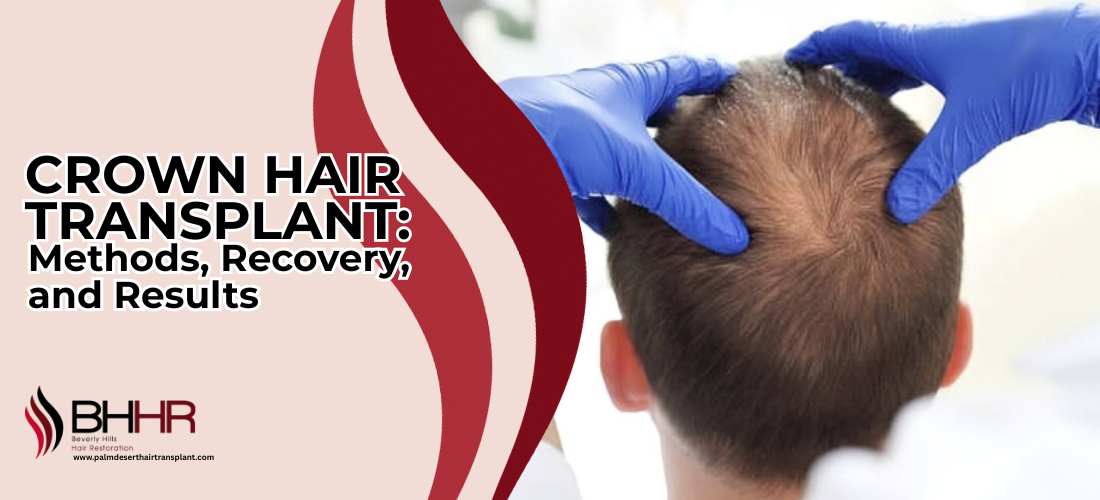 Crown Hair Transplant