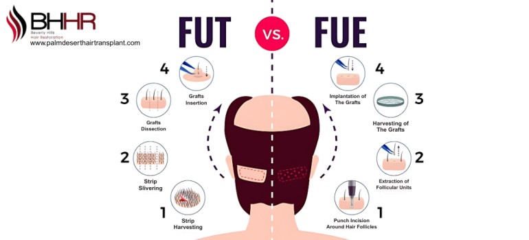 FUE vs FUT hair transplan