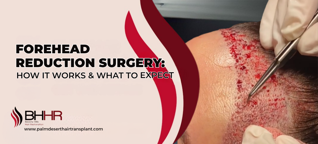 Forehead Reduction Surgery