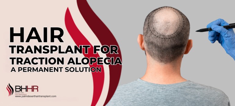 Hair Transplant for Traction Alopecia