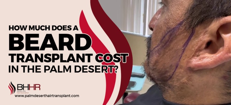 beard transplants Cost