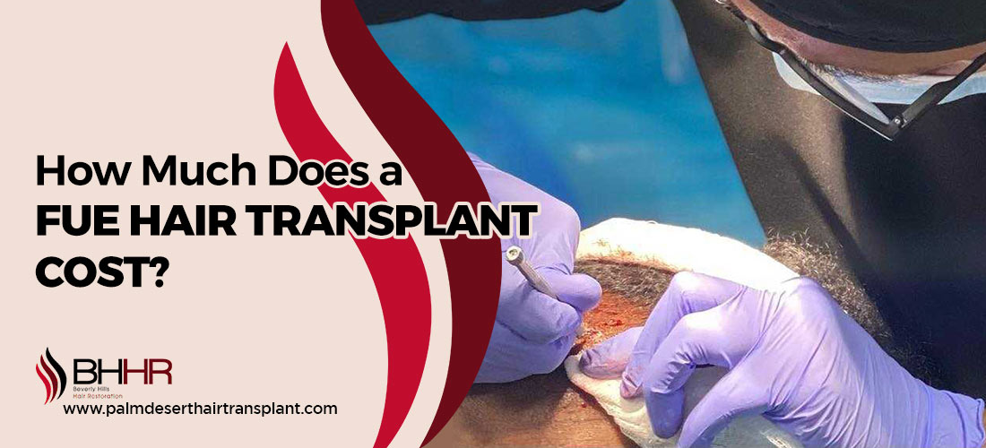 Fue Hair transplant cost