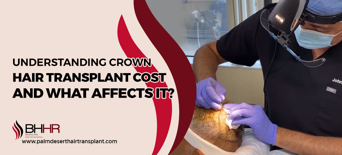 Crown hair transplant Cost
