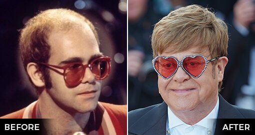 ELTON JOHN'S HAIR TRANSPLANT