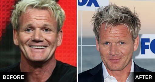 GORDON RAMSAY'S HAIR TRANSPLANT