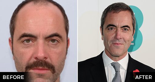 JAMES NESBITT'S HAIR TRANSPLANT