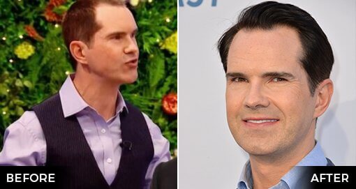 JIMMY CARR'S HAIR TRANSPLANT