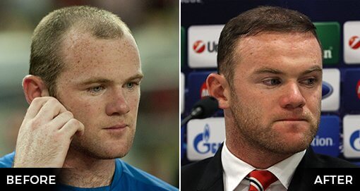 WAYNE ROONEY'S HAIR TRANSPLANT